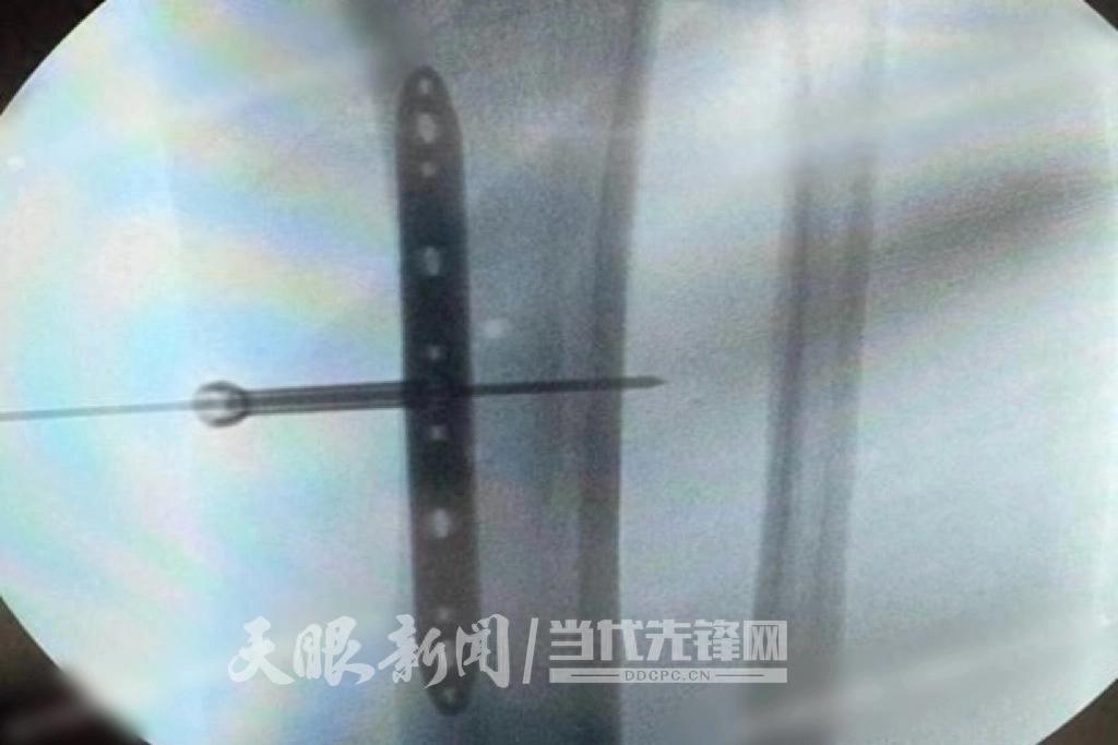 贵州中医大一附院 “保足战役”：中西医结合，成功拯救 76 岁老人糖尿病足插图