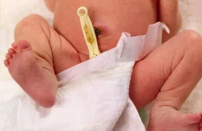 脐风有多危险？解析病症危害、中医熄风止痉方案、急救用药及产后预防
